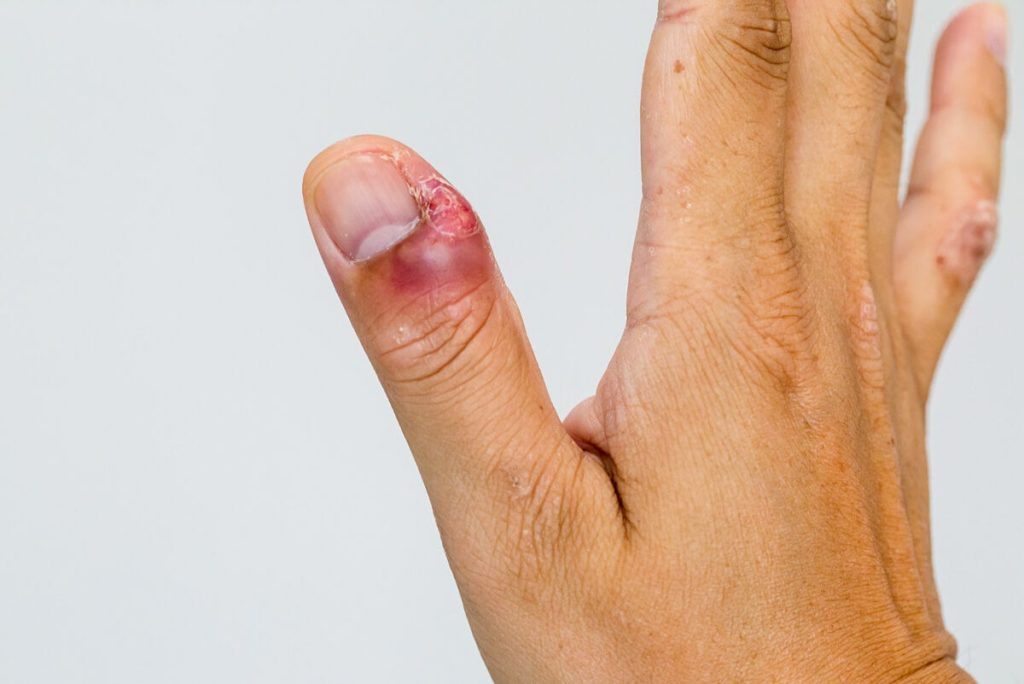 Enfermedades peligrosas para las uñas - NotiFresh.com